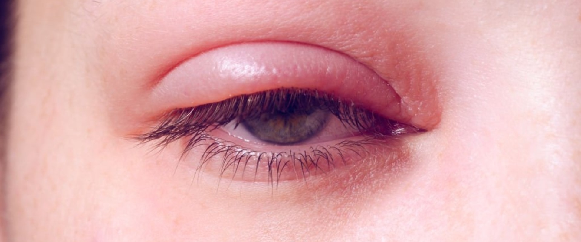 How do you treat infected eyelash extensions?